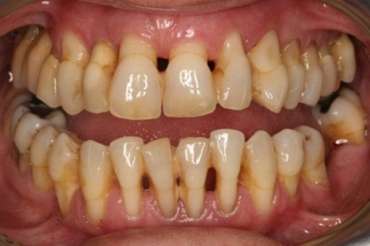 Mòn cổ răng có thật sự nguy hại?
