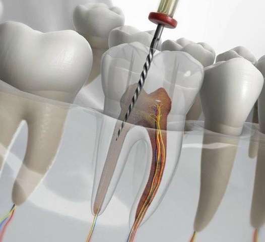 Vì sao răng chữa tủy thường hay thất bại và không giữ được lâu dài?